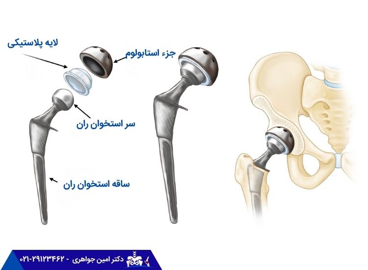 عمل جراحی تعویض مفصل لگن