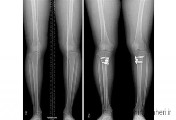 تشخیص پای پرانتزی به کمک تصویر رادیوگرافی