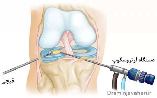 درمان کشیدگی مینیسک زانو با جراحی