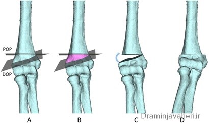 درمان پای پرانتزی با جراحی استئوتومی