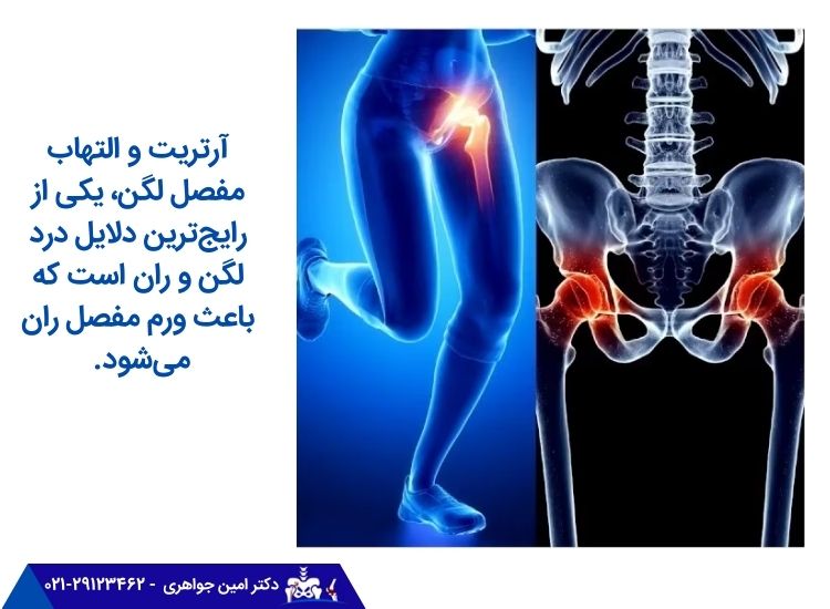 آرتریت و التهاب مفصل لگن