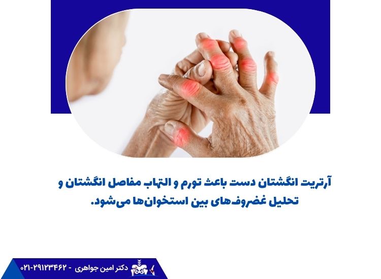 آرتریت انگشتان دست