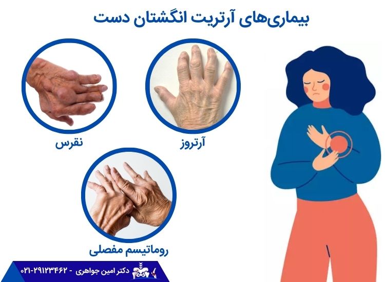 بیماری‌های آرتریت انگشتان دست