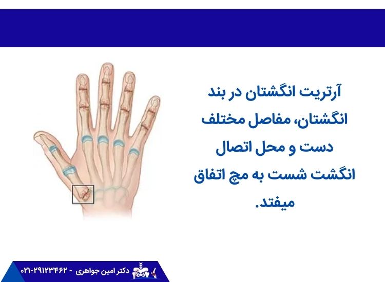 کدام قسمت‌های دست دچار آرتریت انگشتان می‌شوند؟