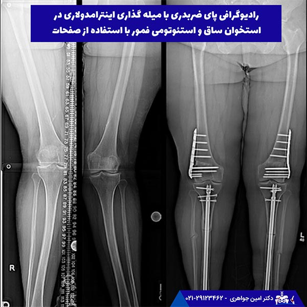 رادیوگرافی پای ضربدری با میله گذاری اینترامدولاری در استخوان ساق و استئوتومی فمور با استفاده از صفحات