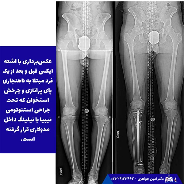 عکس‌برداری با اشعه ایکس قبل و بعد از یک فرد مبتلا به ناهنجاری پای پرانتزی و چرخش استخوان که تحت جراحی استئوتومی تیبیا با نیلینگ داخل مدولاری قرار گرفته است.