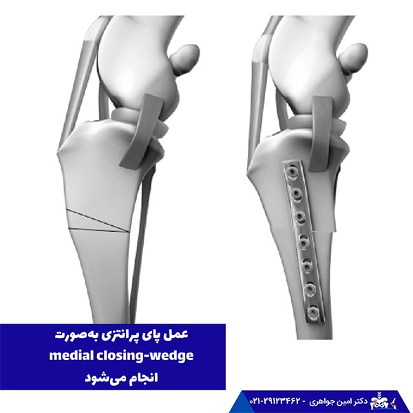 درمان جراحی پای پرانتزی (استئوتومی)
