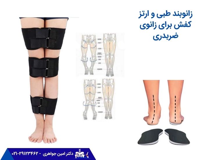 زانوبند طبی و ارتز برای زانوی ضربدری