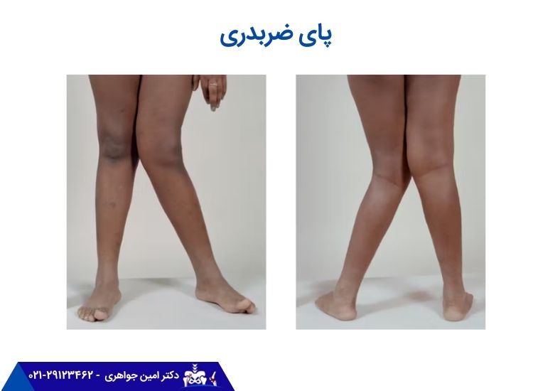 پای ضربدری
