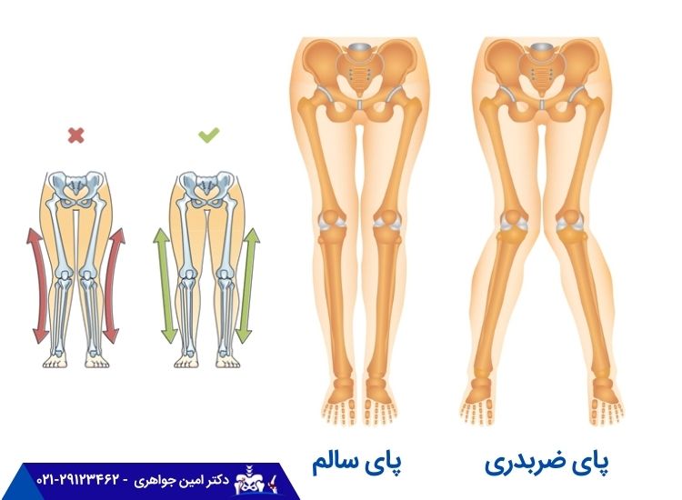 مقایسه پای سالم و پای ضربدری