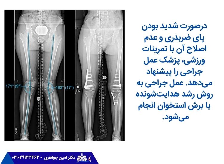 جراحی زانوی ضربدری