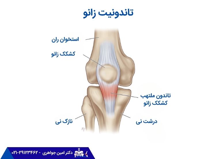 تاندونیت زانو