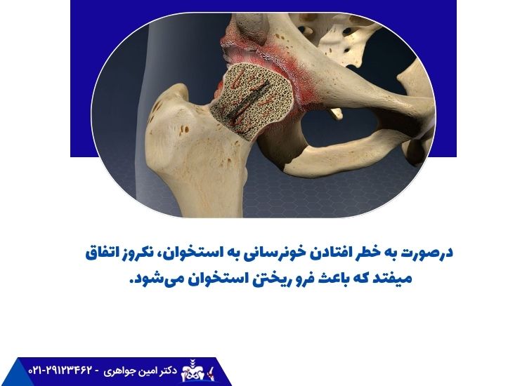 نکروز استخوان، خونرسانی به استخوان را مختل می‌کند.