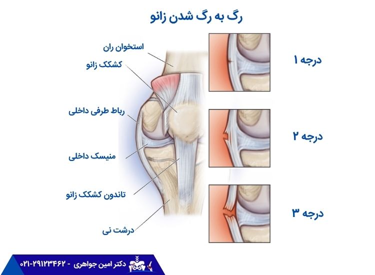 رگ به رگ شدن زانو و درجات آن