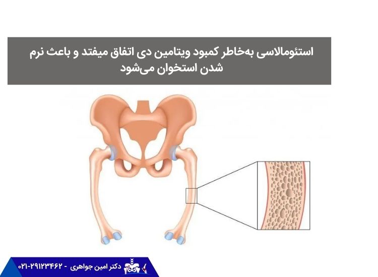 استئومالاسی به نرمی استخوان اشاره دارد.