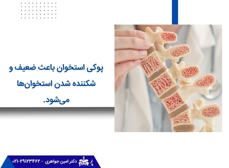 پوکی استخوان، مهم‌ترین علامت درد استخوان است. 