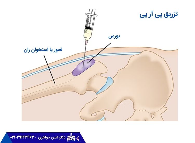 تزریق پلاسمای غنی از پلاکت برای درمان بورسیت لگن