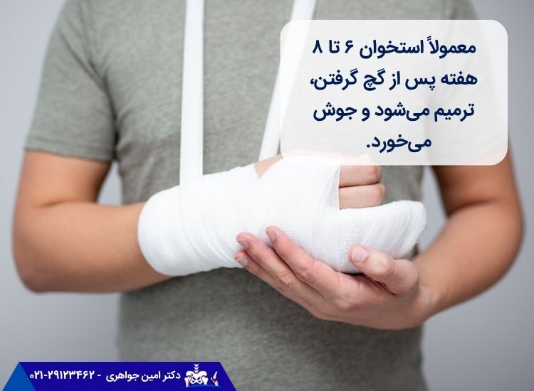 زمان بهبودی بعد از گچ گرفتن استخوان