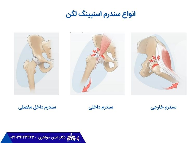 3 نوع سندرم اسنپینگ لگن