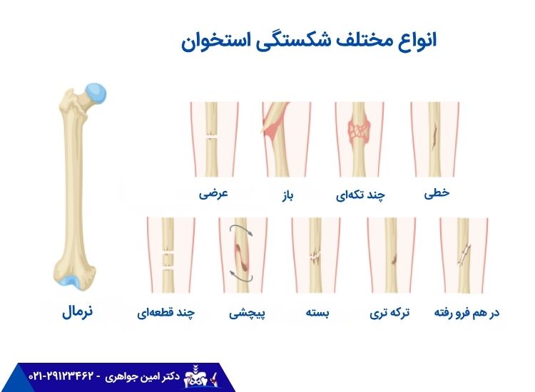 انواع مختلف شکستگی استخوان