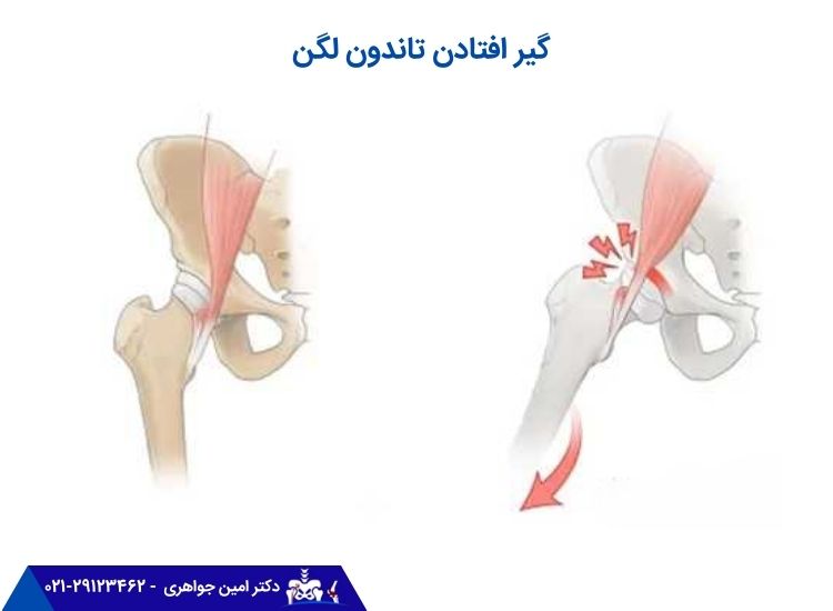 گیر افتادن تاندون لگن