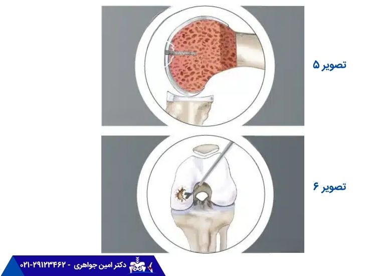 ترمیم ضایعات کم عمق و عمیق غضروف زانو
