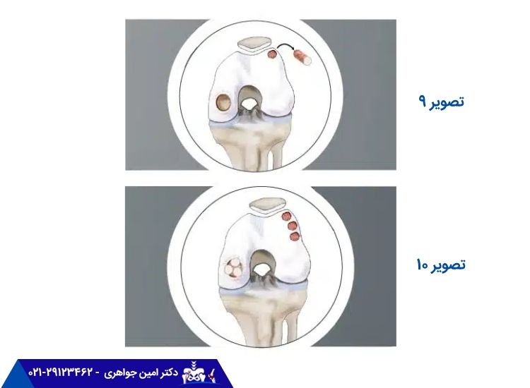 ترمیم غضروف زانو با کمک تکنیک موزائیک پلاستی