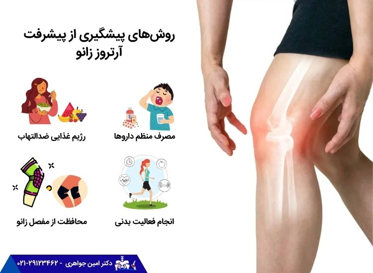 روشهای پیشگیری از پیشرفت آرتروز زانو