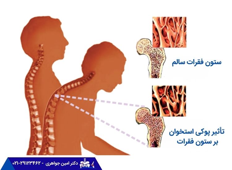 تأثیر پوکی استخوان بر ستون فقرات