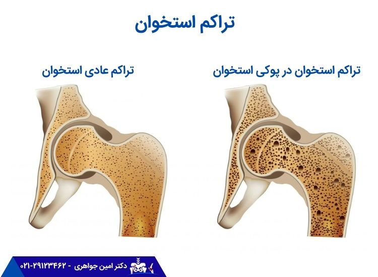 تراکم استخوان 