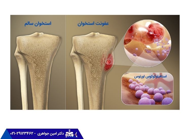 عفونت استخوان