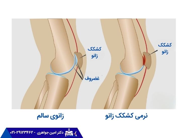 نرمی کشکک زانو