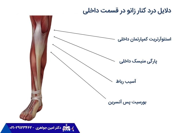 درد کنار زانو در قسمت داخلی