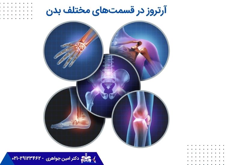 آرتروز در قسمتهای مختلف بدن
