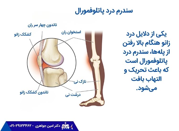 یکی از دلایل درد زانو هنگام بالا رفتن از پلهها، سندرم درد پاتلوفمورال است