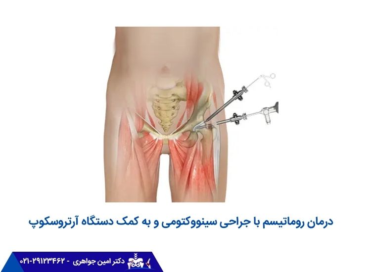 درمان روماتیسم با جراحی سینووکتومی