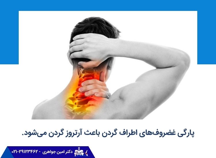پارگی غضروف های اطراف گردن باعث آرتروز گردن می‌شود.