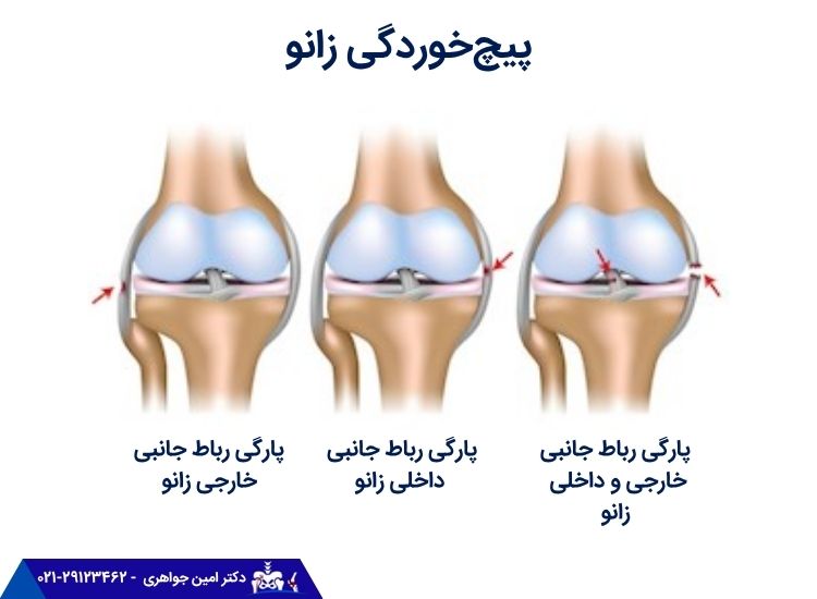 پیچ‌خوردگی زانو