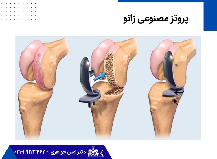 پروتز مصنوعی زانو