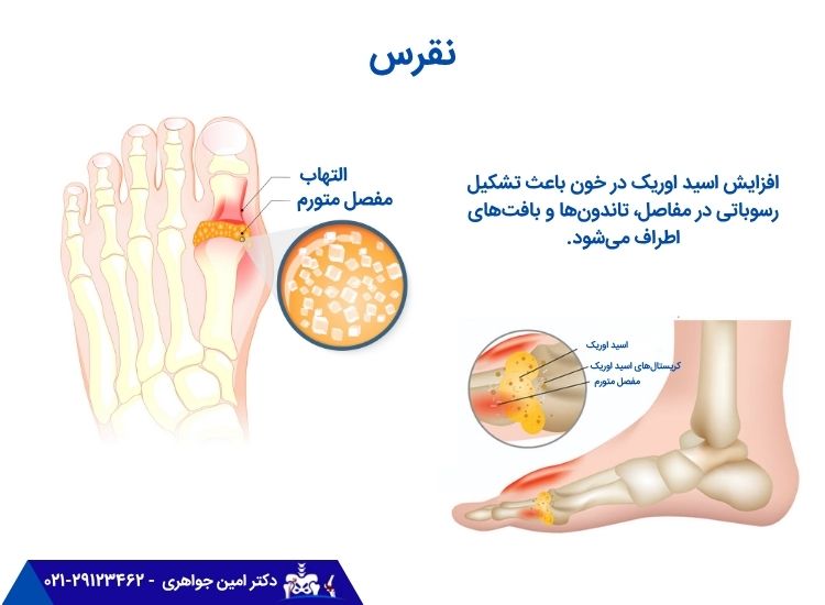 نقرس یکی از دلایل خشکی مفصل است.
