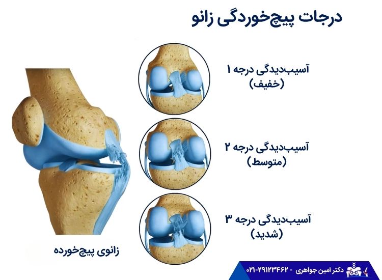 درجات مختلف پیچ‌خوردگی زانو