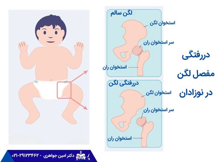 دررفتگی مفصل لگن در نوزادان