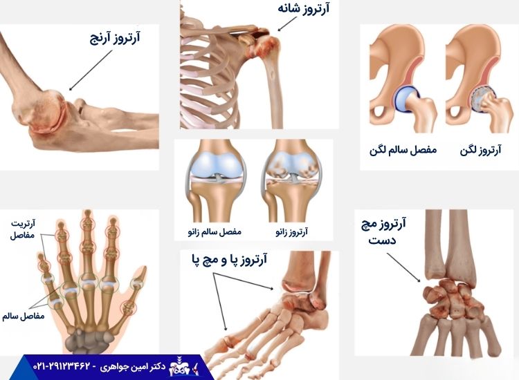 بیماری آرتروز یکی از دلایل خشکی مفصل است.