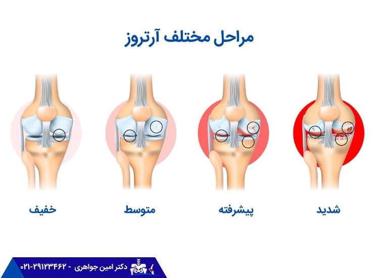 مراحل مختلف آرتروز