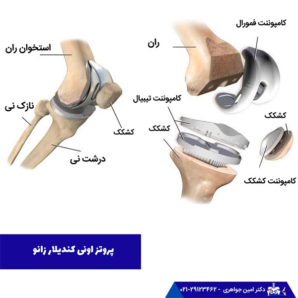 پروتز اونی کندیلار زانو