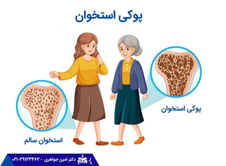 پوکی استخوان