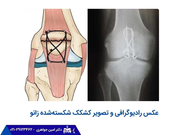 عکس رادیوگرافی و تضویر کشکک شکسته شده زانو
