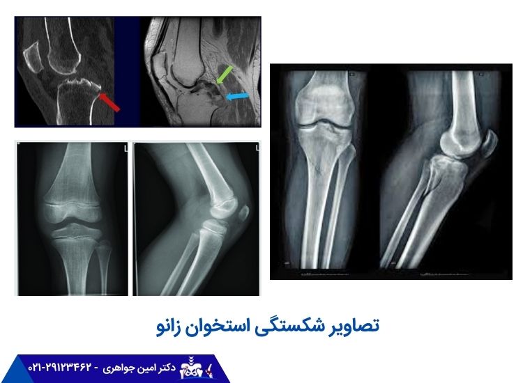 تصاویر شکستگی استخوان زانو