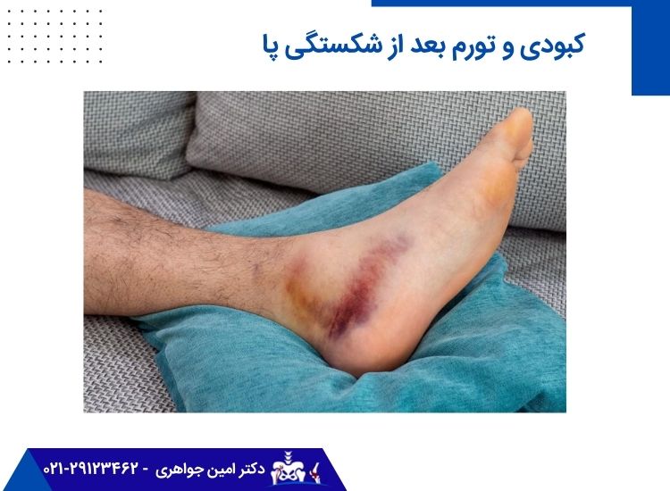 کبودی و تورم بعد از شکستگی پا