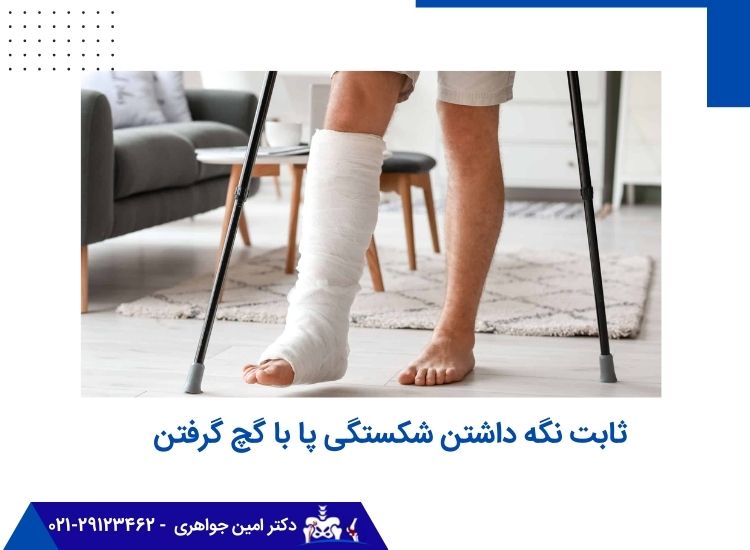 ثابت نگه داشتن شکستگی پا با گچ گرفتن